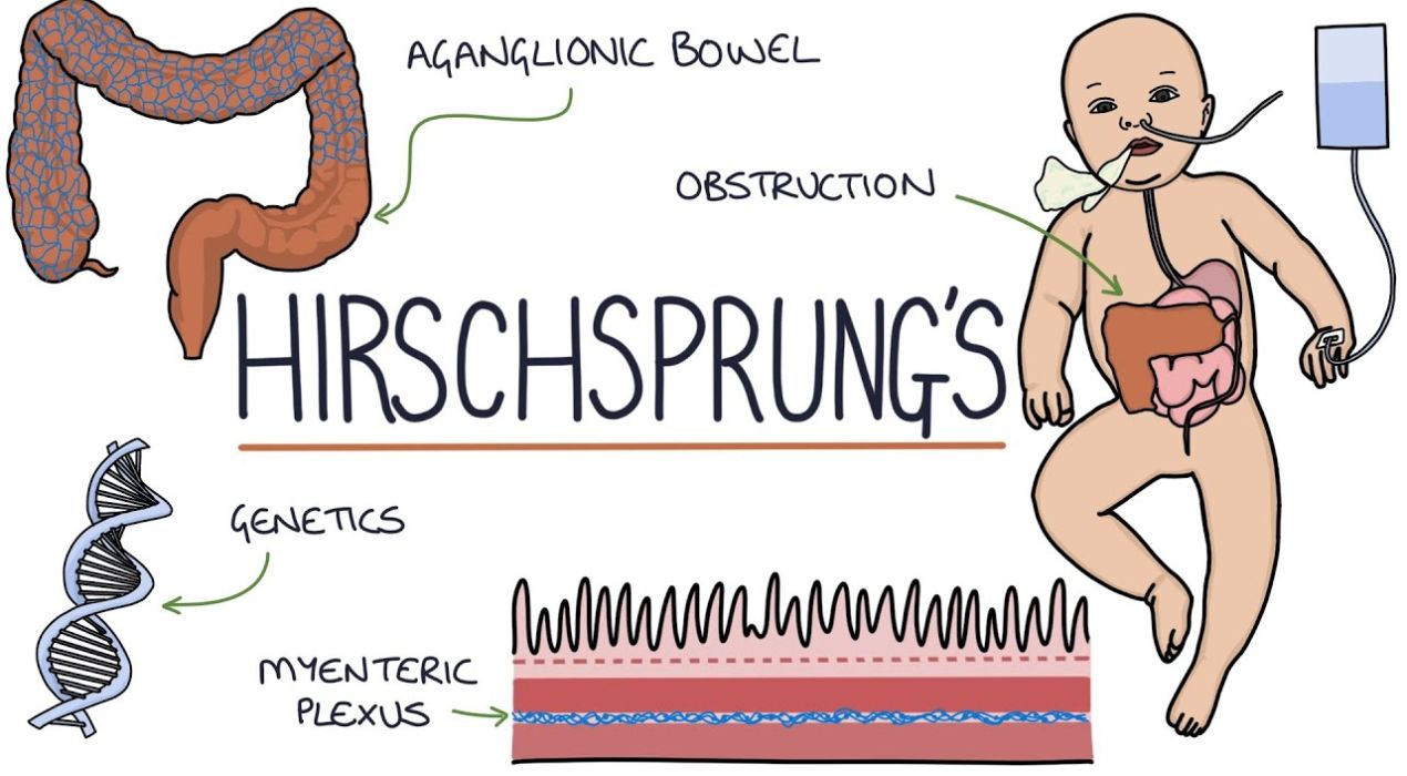 اعراض مرض هيرشسبرنج عند الاطفال وطرق علاجه