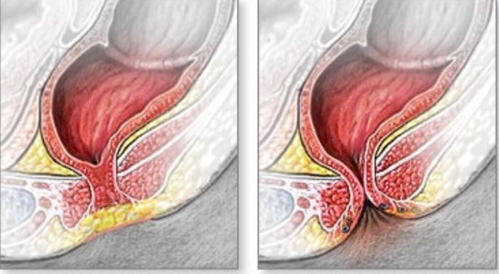 انسداد فتحة الشرج