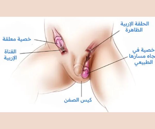  عملية الخصية المعلقة للاطفال