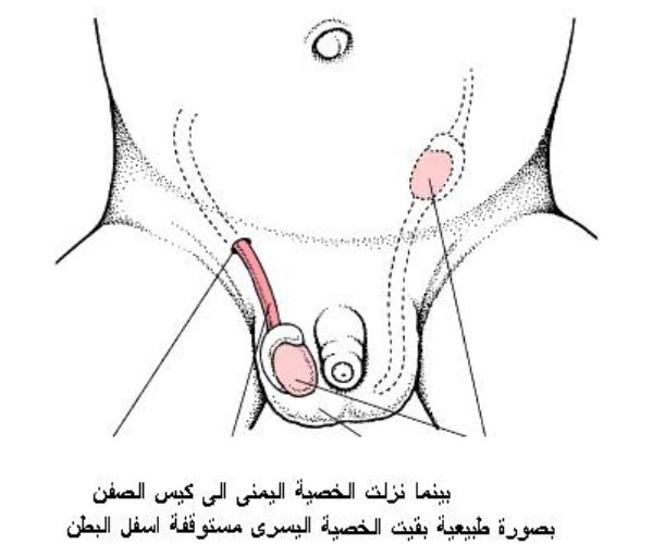 الخصية المعلقة عند الاطفال بالصور