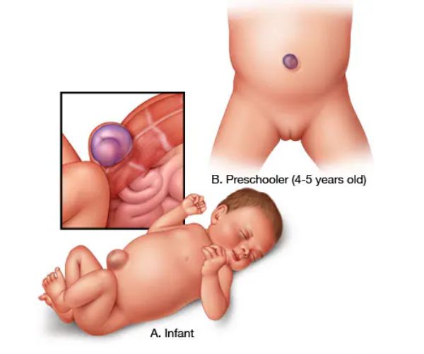 الفتق السرى عند الاطفال