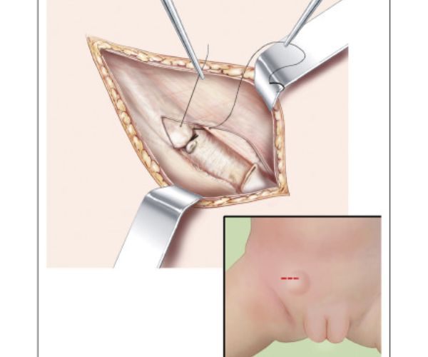عملية الفتق الاربي للاطفال