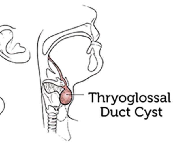 الكيس الدرقي اللساني
