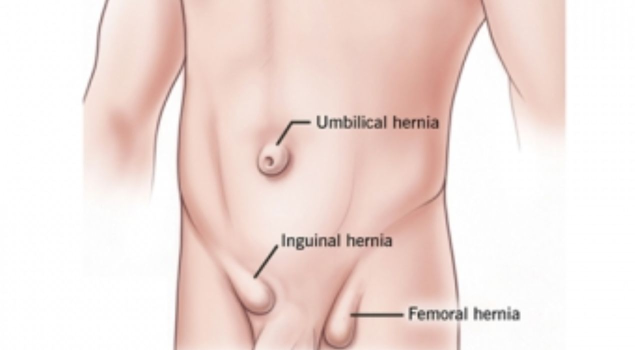 بالصور شكل الفتق الأربي عند الرضع وطرق علاجه