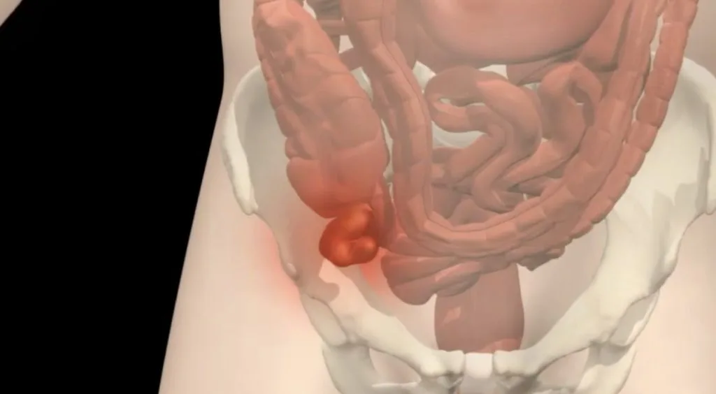 ما هي اعراض انفجار الزائده عند الاطفال؟ _ الأستاذ الدكتور خالد صلاح 8 انفجار الزائده
