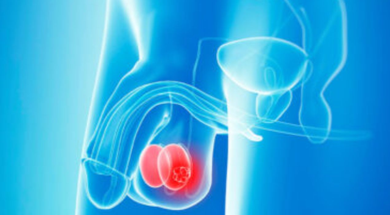 تعرف علي أسباب ورم الخصية بالصور ، وطرق علاجه