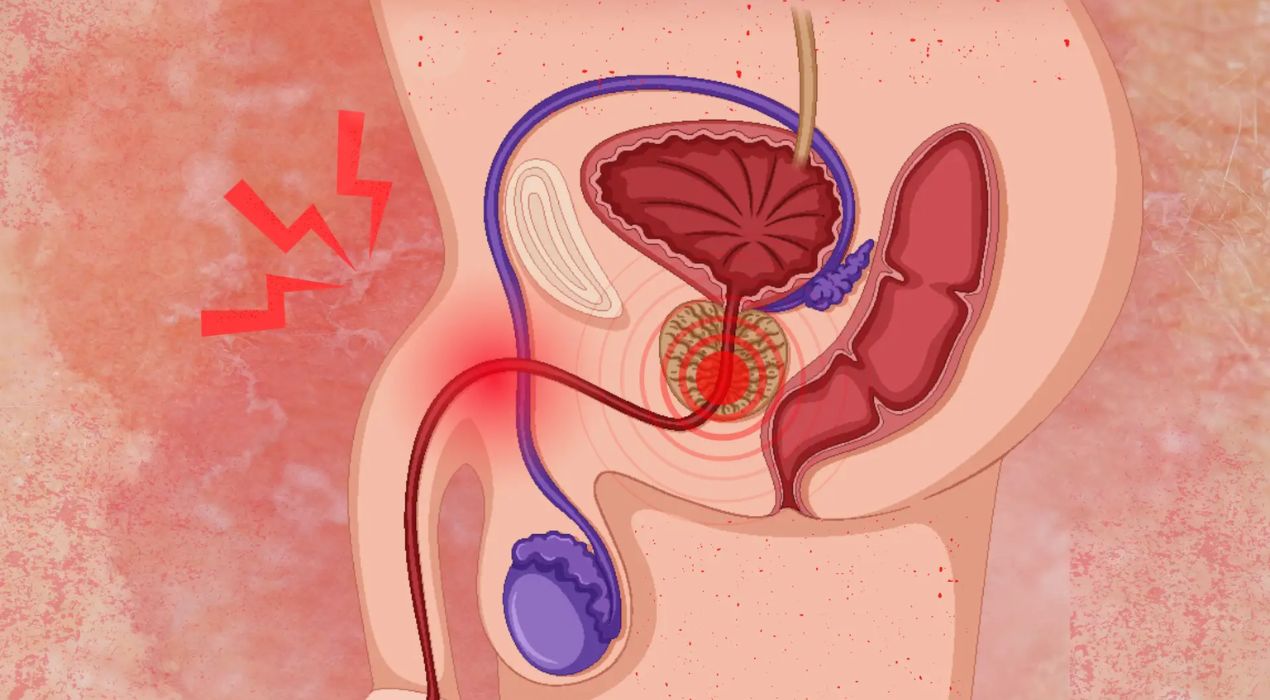 أعراض ضيق مجرى البول وأسبابه وطرق علاجه