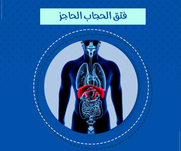 اعراض الفتق في الحجاب الحاجز