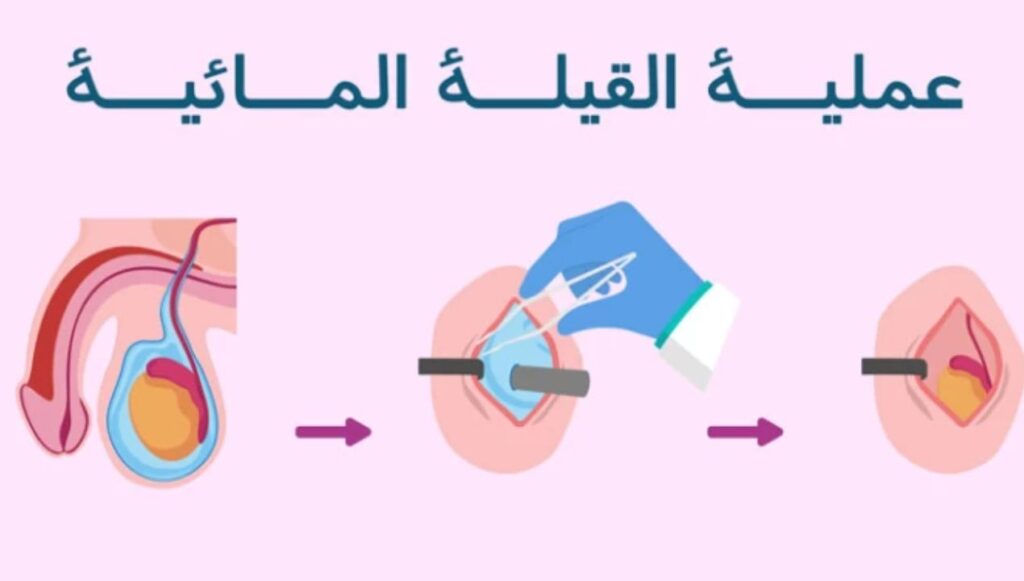 شكل الخصية بعد عملية القيلة المائية