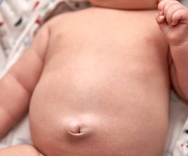شكل الفتق السري عند الرضع