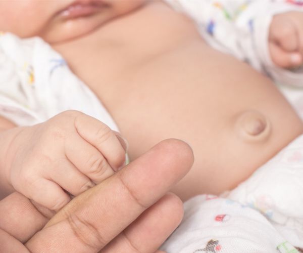 شكل الفتق السري عند الرضع