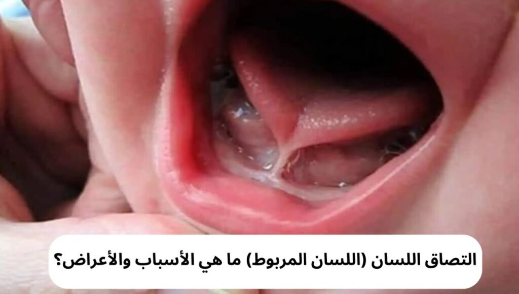 اللسان المربوط