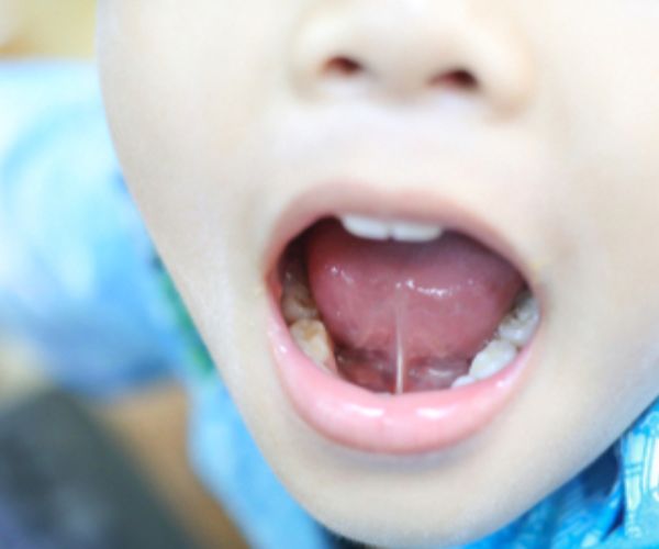 اللسان المربوط