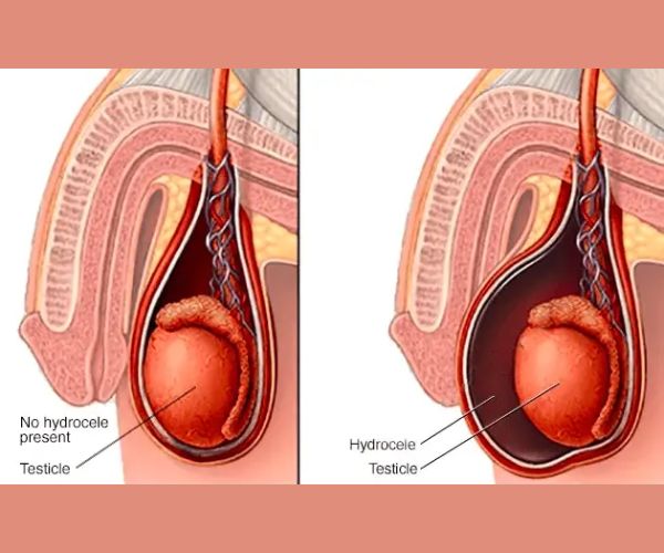 شكل الخصية بعد عملية القيلة المائية