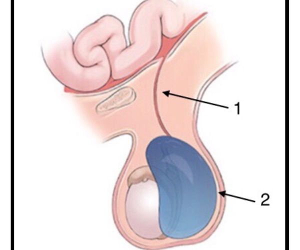 شكل الخصية بعد عملية القيلة المائية