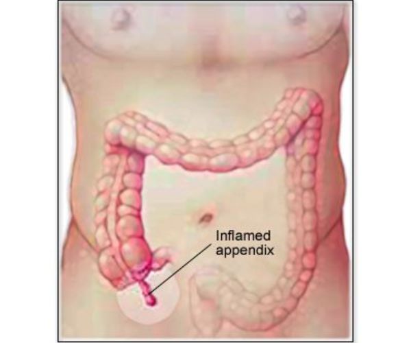 المضاعفات بعد عملية الزائدة الدودية