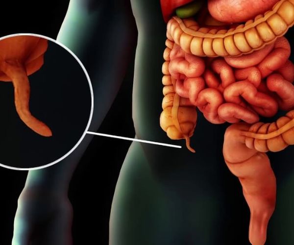 المضاعفات بعد عملية الزائدة الدودية