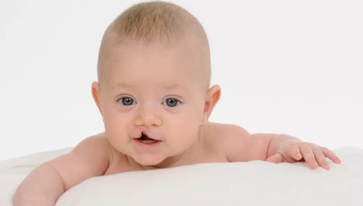 اسباب الشفة الارنبية وكيف يتم علاجها؟