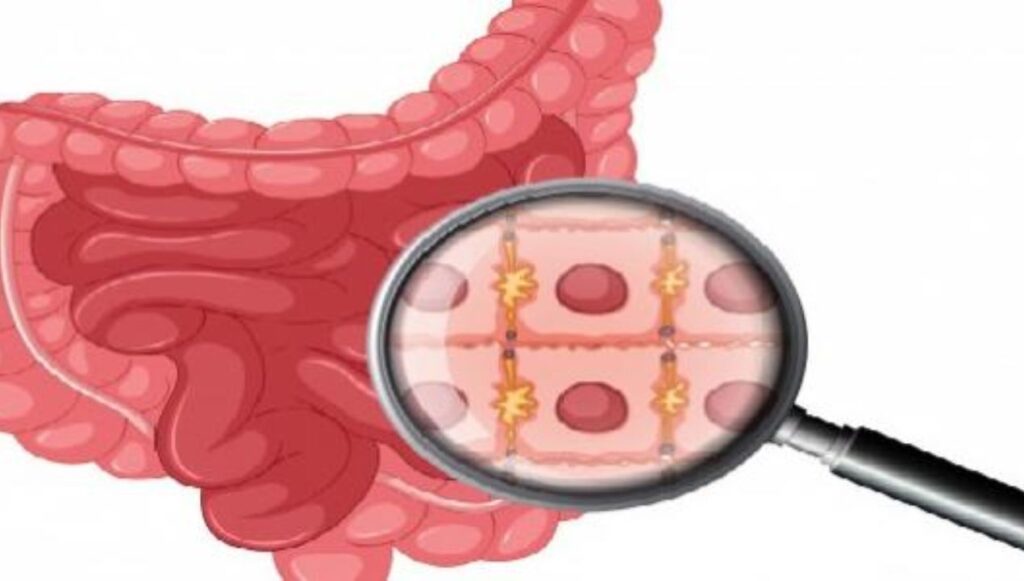 التهاب الامعاء عند الاطفال