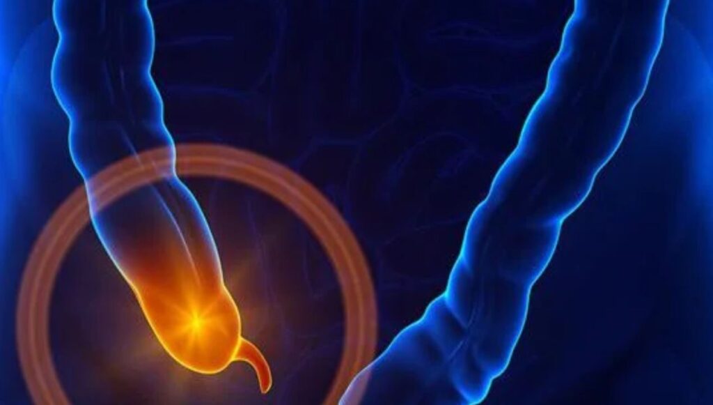 انفجار الزائدة الدودية