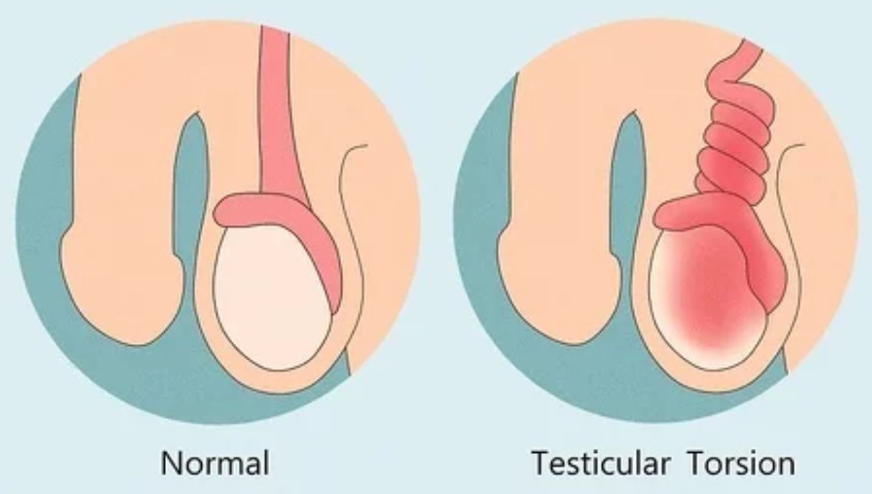 أسباب انتفاخ كيس الصفن عند الأطفال