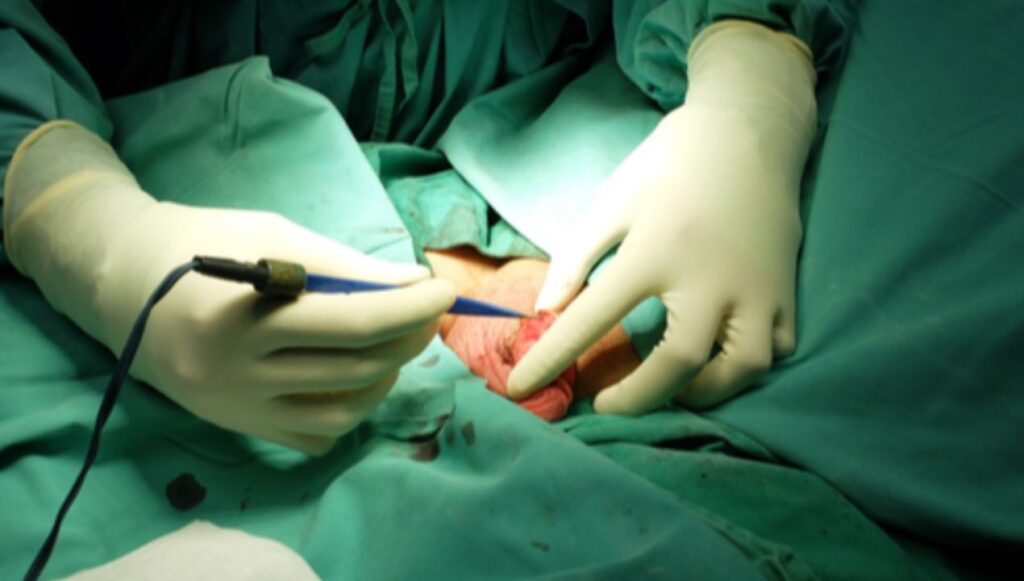 سلبيات الختان بالليزر