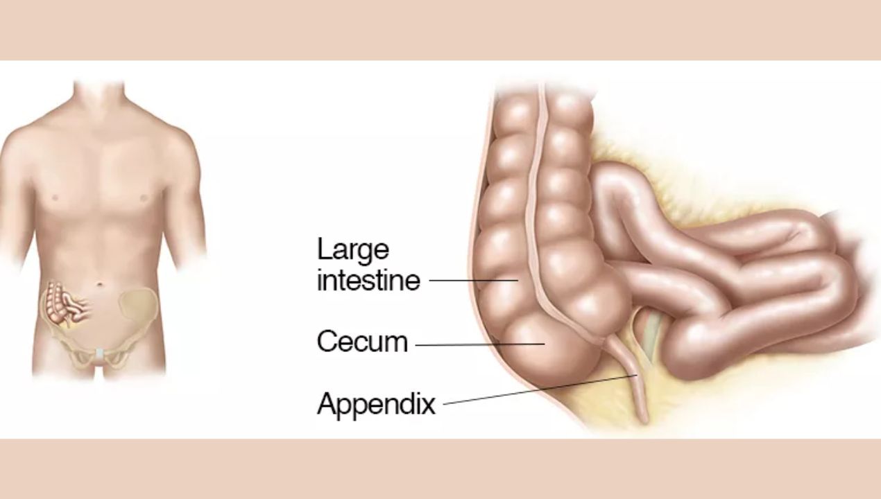 ما هي مضاعفات استئصال الزائدة الدودية؟