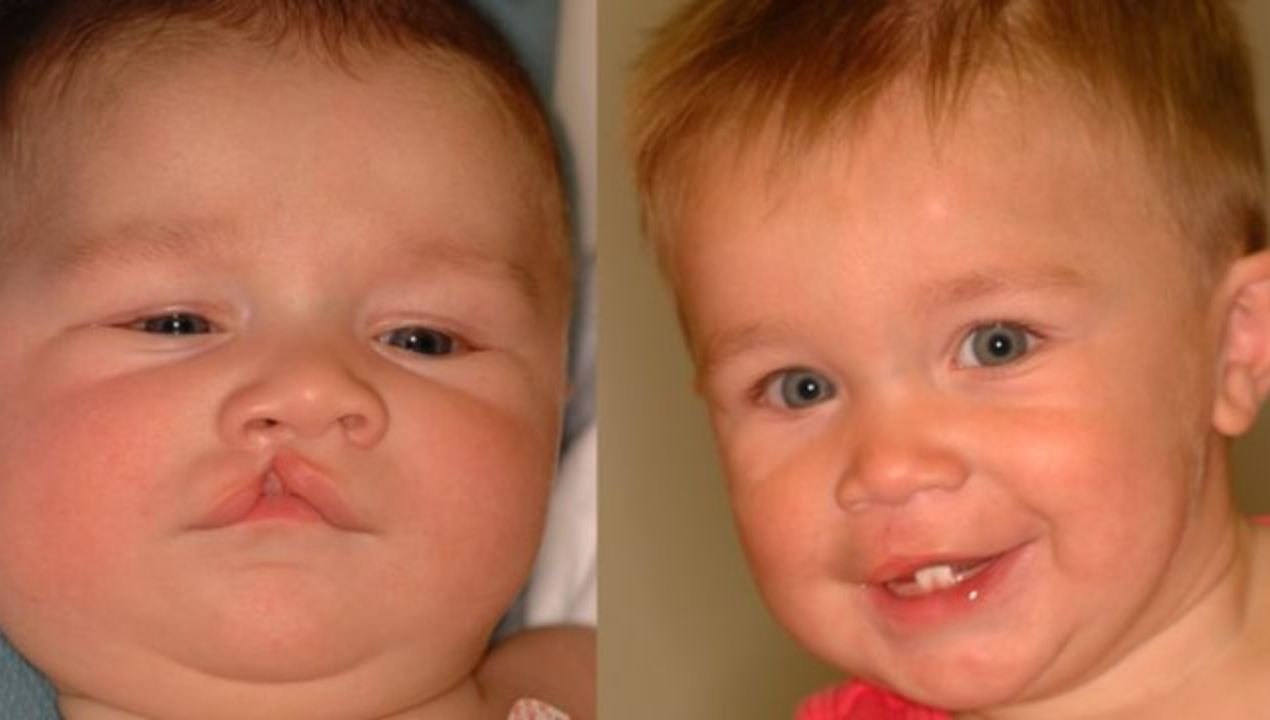 بالصور شكل الشفة الارنبية قبل وبعد العملية