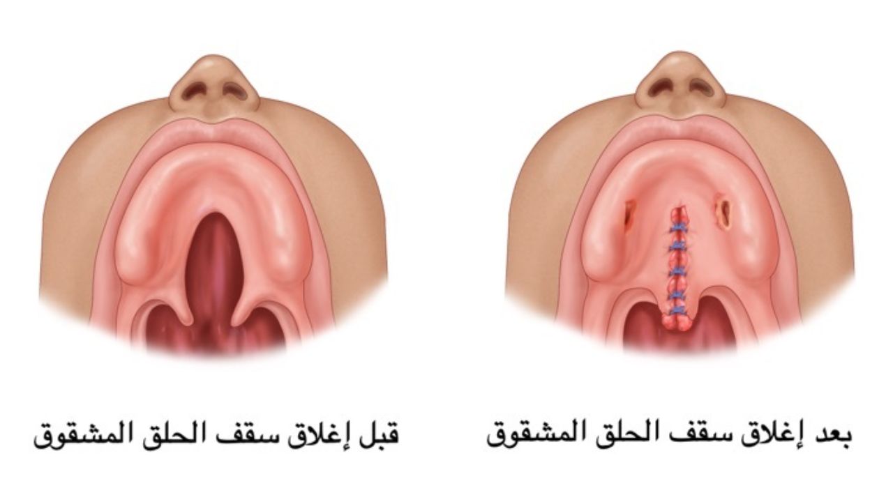 أسباب سقف الحلق المشقوق عند الاطفال