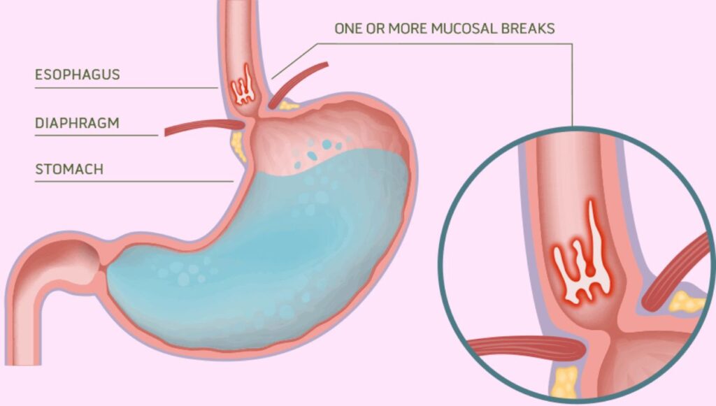 علاج التهابات المرئ