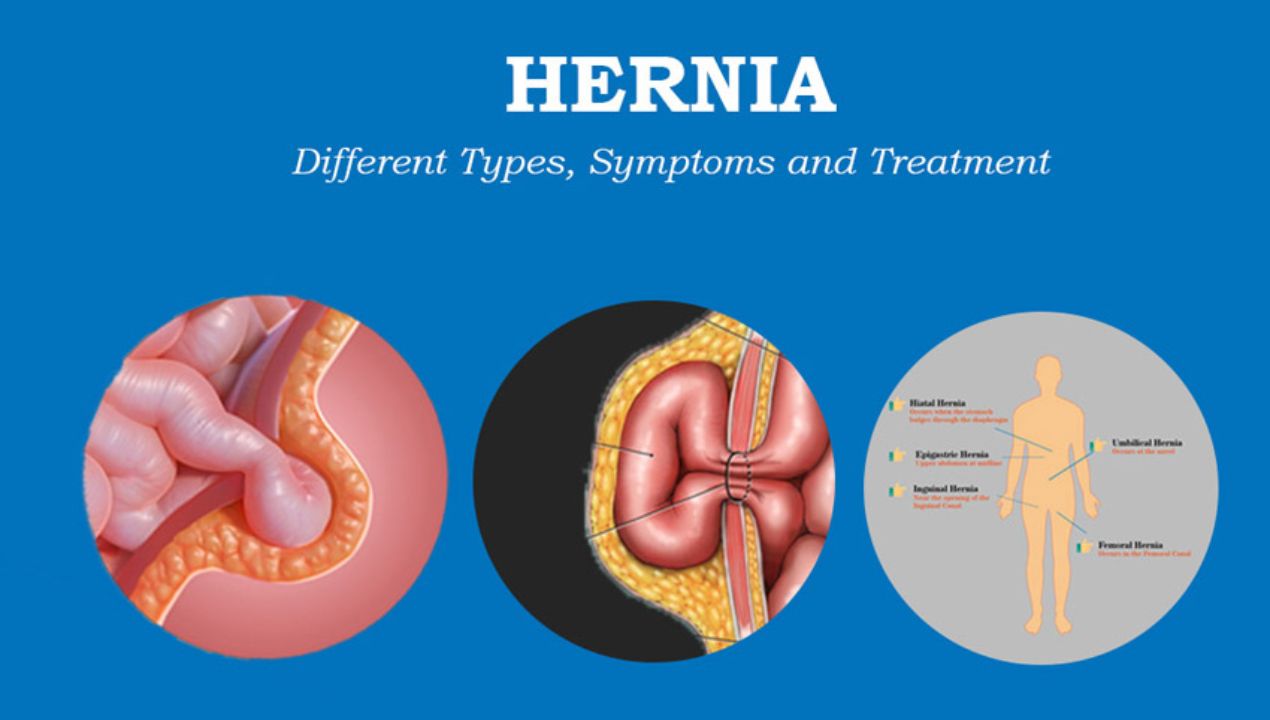 دليل شامل: انواع الفتاق للأطفال وأسباب وعلاج كل منهم