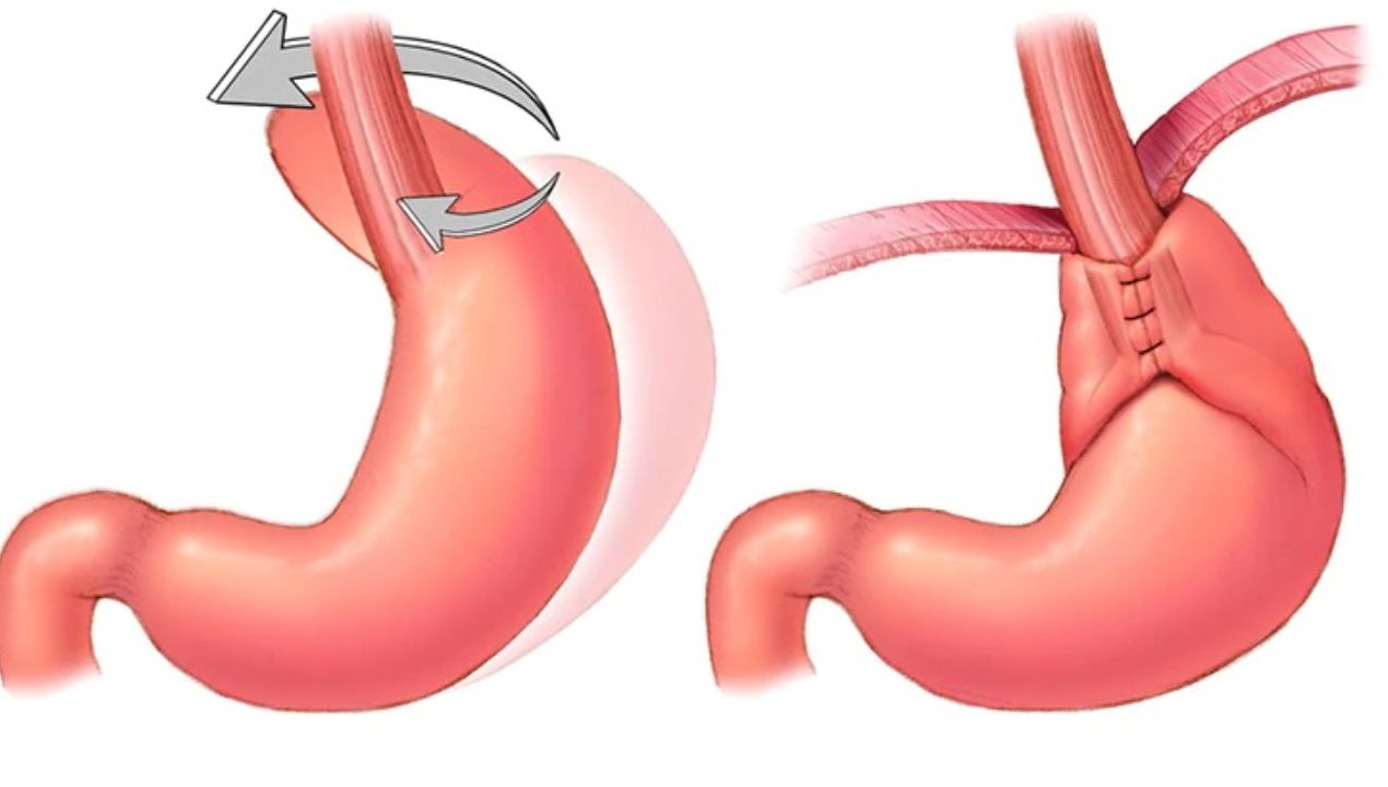 دليل شامل عن : أسباب عملية ارتجاع المريء
