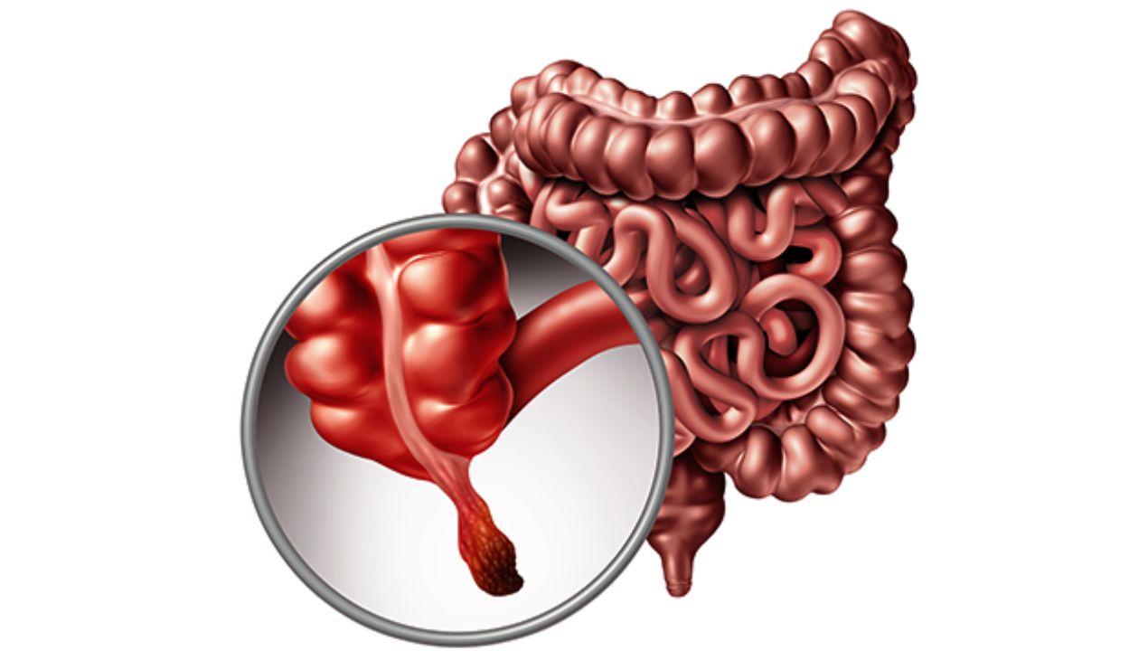 تعرف علي اعراض انفجار الزائدة الدودية عند الاطفال