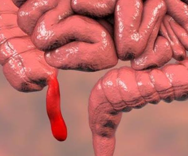 انفجار الزائدة الدودية