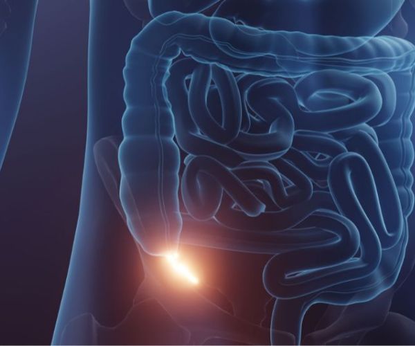 انفجار الزائدة الدودية