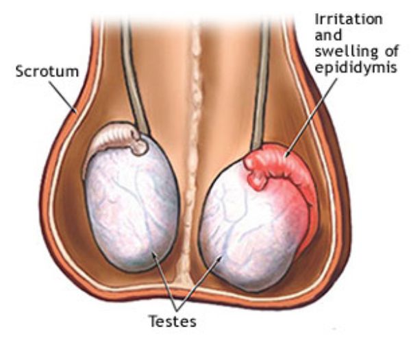 انتفاخ كيس الصفن