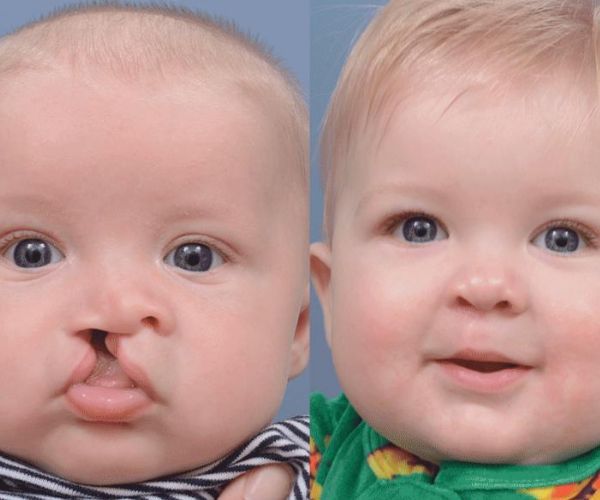 شكل الشفة الارنبية