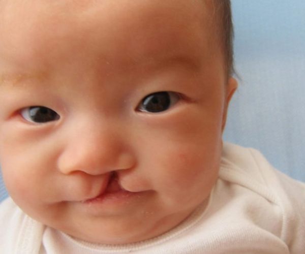 شكل الشفة الارنبية