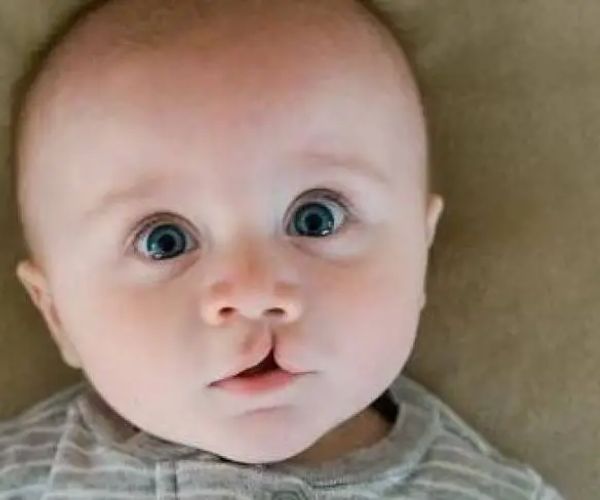 شكل الشفة الارنبية