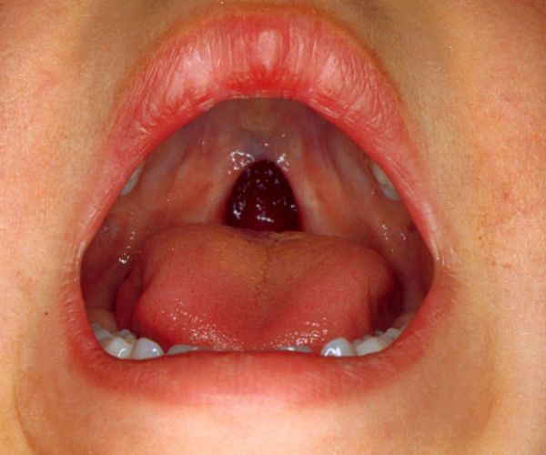 سقف الحلق المشقوق