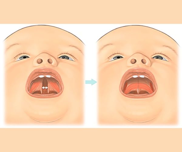 سقف الحلق المشقوق