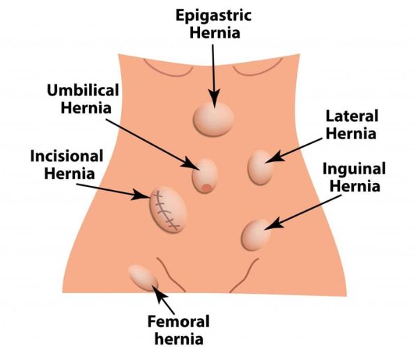 انواع الفتاق