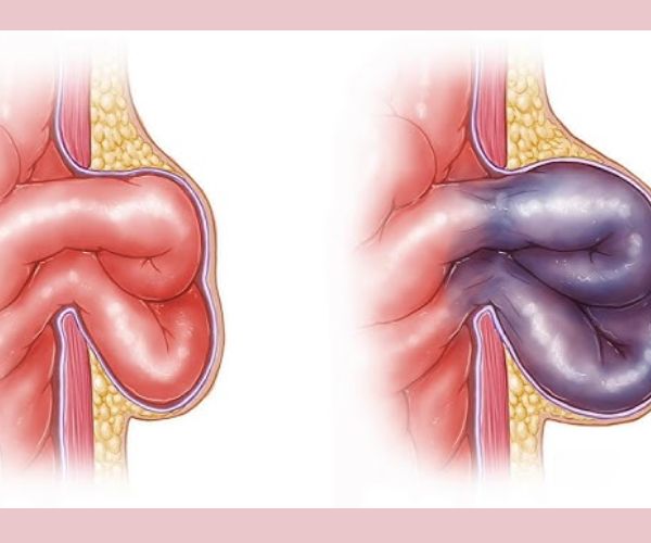 انواع الفتاق