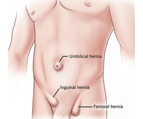  عملية الفتق الإربي