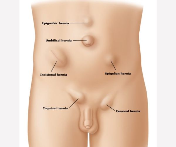  عملية الفتق الإربي
