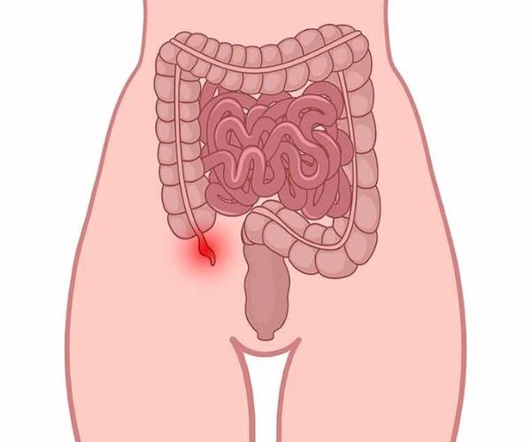 انفجار الزائدة الدودية