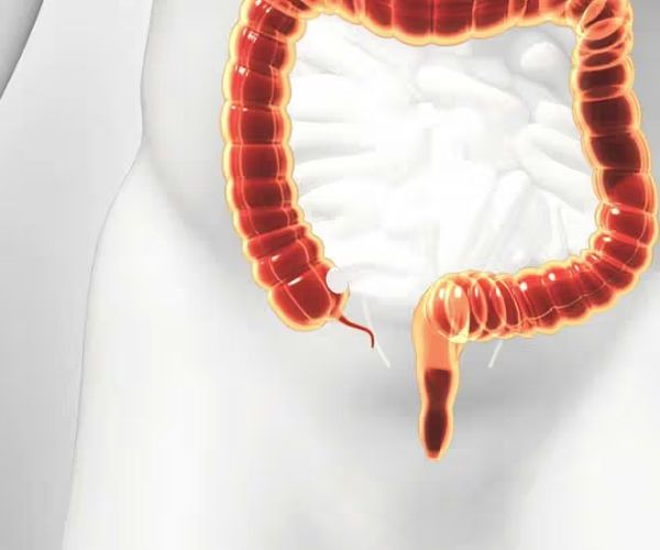 انفجار الزائدة الدودية