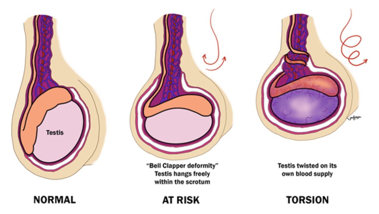 اسباب التواء الخصية وأعراضها وطرق علاجها