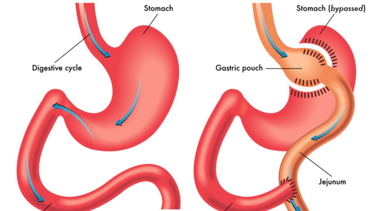 ما هي عملية التفاف المعدة وما اسبابها واعراضها؟
