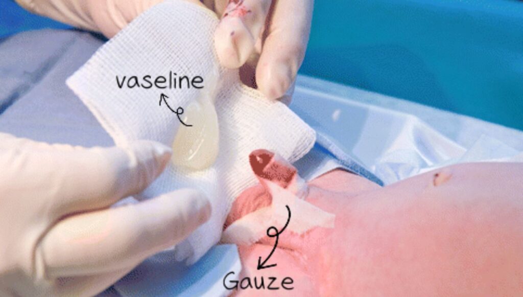 علاج التصاق الجلد بالحشفة بعد الختان